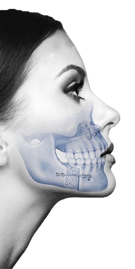 Corrective Jaw Surgery